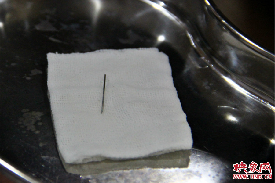 上午11點(diǎn)30分許，小龍腦中鋼針已經(jīng)成功取出。