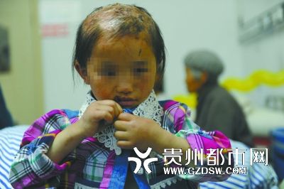 被燙傷的頭皮一直沒有愈合。