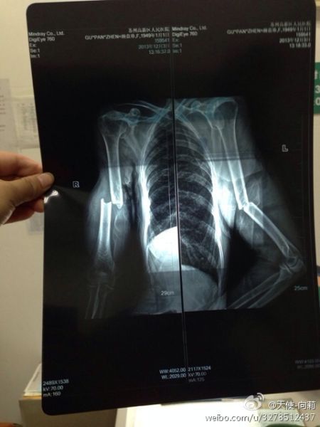 圖為微博上傳“范某某的妻子顧盤(pán)珍手被打斷。”