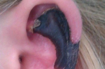 荷蘭女子旅游途中被蜘蛛咬，耳軟骨溶解變黑。