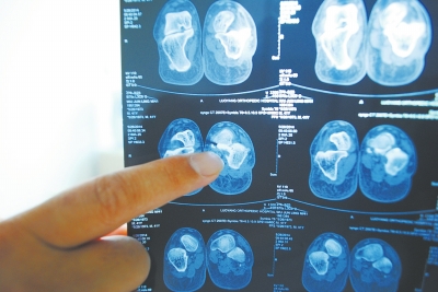 X光片顯示,確實(shí)有一根殘留的螺絲釘。