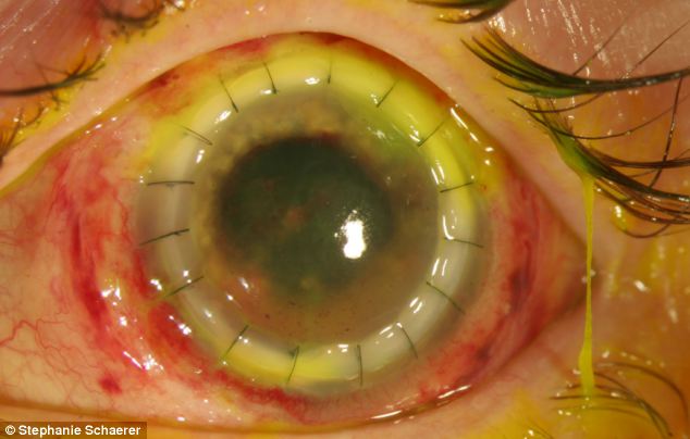 恐怖慎入！隱形眼鏡致英女子摘除眼球