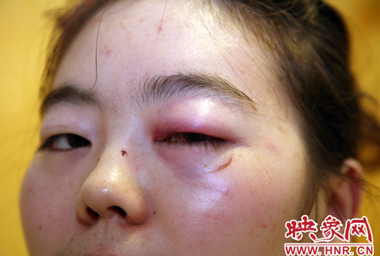 距離被打已經(jīng)整整20幾個(gè)小時(shí)了,小陳眼上紅腫還沒退去 距離被打已經(jīng)整整20幾個(gè)小時(shí)了,小陳眼上紅腫還沒退去