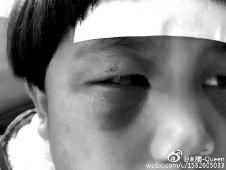 6月2日，網(wǎng)曝渭南市臨渭區(qū)一不滿5歲的女童遭奶奶毆打，眼圈青腫，引起網(wǎng)友關(guān)注，但孩子父母和爺爺均稱是摔倒導(dǎo)致。相關(guān)部門介入調(diào)查發(fā)現(xiàn)確為奶奶毆打所致，鑒于其身體原因已進(jìn)行批評(píng)教育。