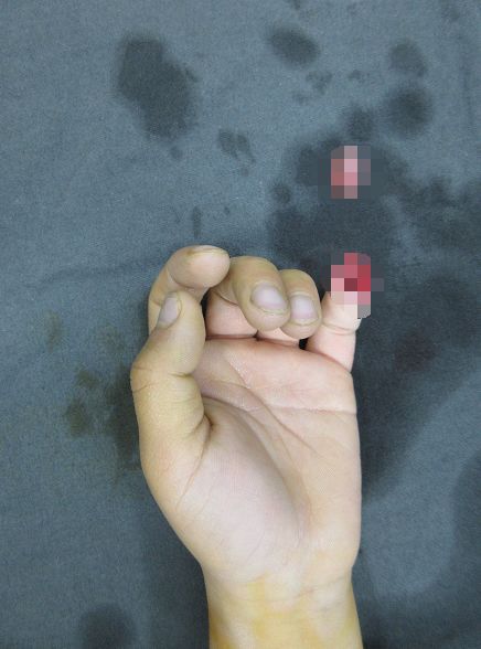 嚇哭！6歲男孩被夾斷手指 罪魁禍?zhǔn)拙故切７? oldsrc=