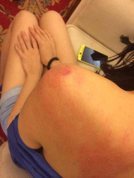 “跑男”真的很拼！baby朋友圈曬后背紅腫照