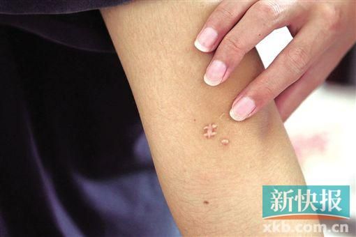 取出針后李星兒手臂留下了傷口。新快報記者 張國鋒/攝