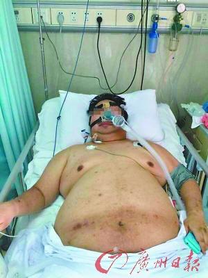 男子作息紊亂體重升至180公斤 搶救時壓塌2張病床 男子作息紊亂體重升至180公斤 搶救時壓塌2張病床