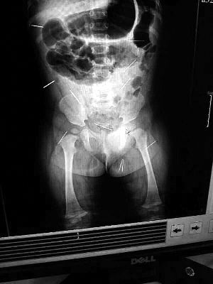 目前體內(nèi)的12根鋼針多分布在孩子的臀部，一根在腹部，其余3根在胸腔附近，其中一根很接近心臟