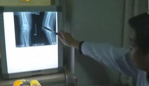 冷空氣來襲 如何預(yù)防老寒腿？