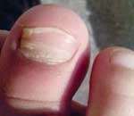 一幼兒園兒童“指甲異?！? title=